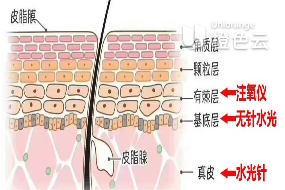 注氧仪